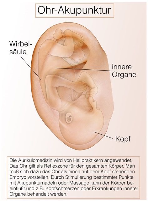 Ohrakupunktur